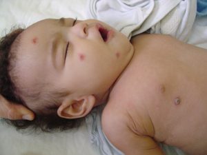 Κλινική Περίπτωση 4: Αγόρι ηλικίας 3 ετών από τη Σρι Λάνκα με “ επίμονο σταφυλοκοκκικό εξάνθημα”, διάσπαρτο στο δέρμα