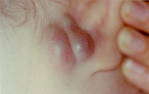 Κλινική Περίπτωση 6: Φυματίωση του έξω ακουστικού πόρου με την σύγχρονη προσβολή της μαστοειδούς αποφύσεως.